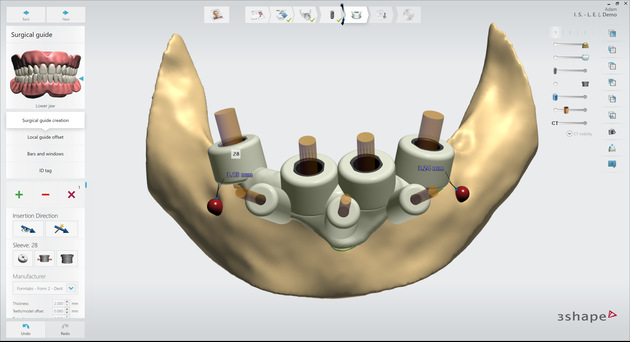 Implant Studio 植牙手術引導版 1