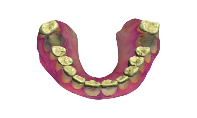 Dental System 牙科修復軟體 2