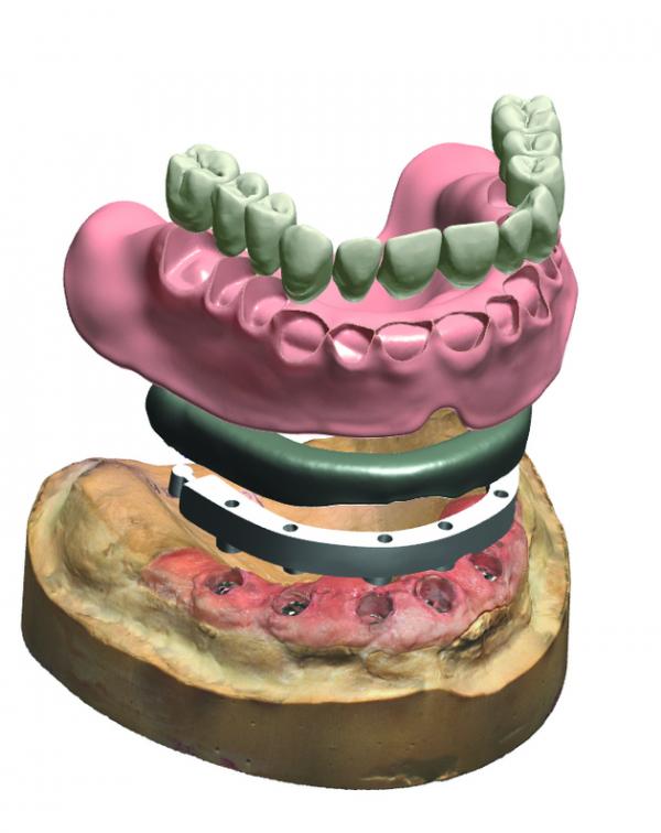 Dental System 牙科修復軟體